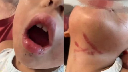  3岁女童被暴力喂食，2分钟后被男幼师拎起胳膊带走